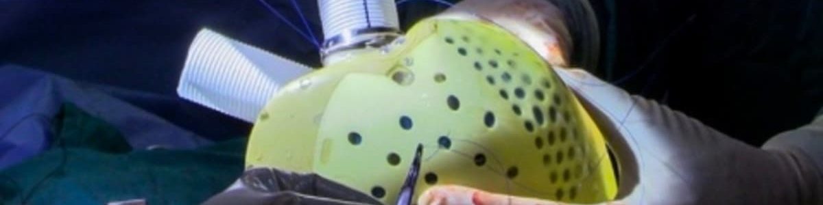 Primeiro coração totalmente artificial transplantado com sucesso num paciente