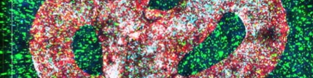 Tumor cerebral maligno impresso em 3D pela primeira vez